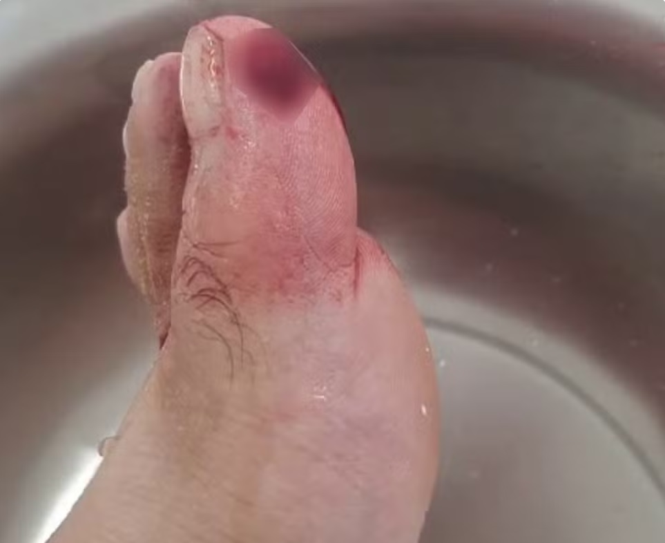 Banhista atacado por piranha precisou de atendimento m&eacute;dico, em Rosana (SP) - Foto: Cristiano Oliveira de Carvalho